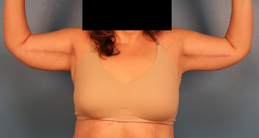 Case--1912 | After Brachioplasty