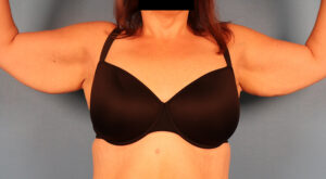 Case--57575 | Before Arm Lift (Brachioplasty) 1