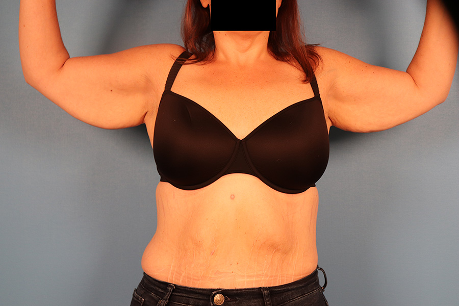 Case--1912 | Before Brachioplasty