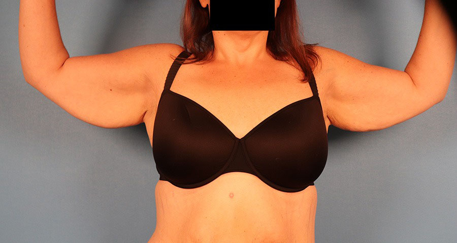 Case--1912 | Before Brachioplasty