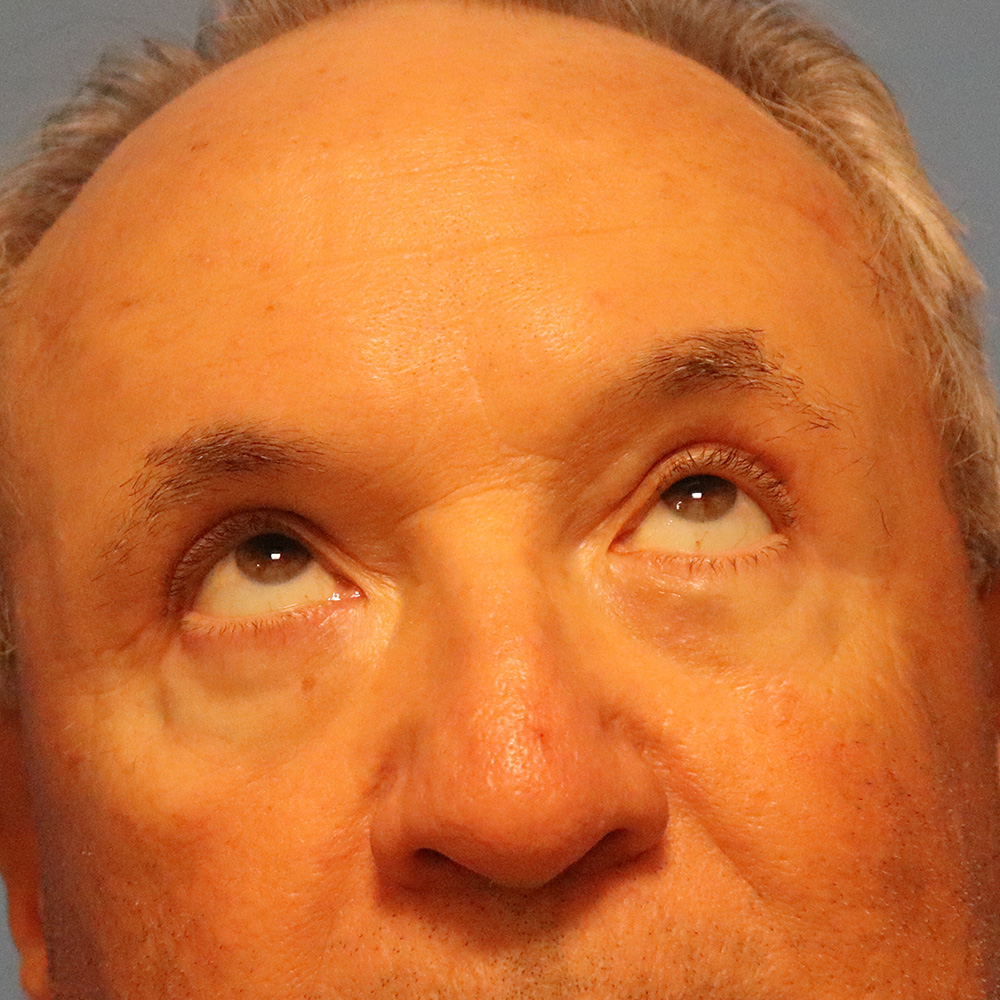Case--7502 | After Blepharoplasty 2