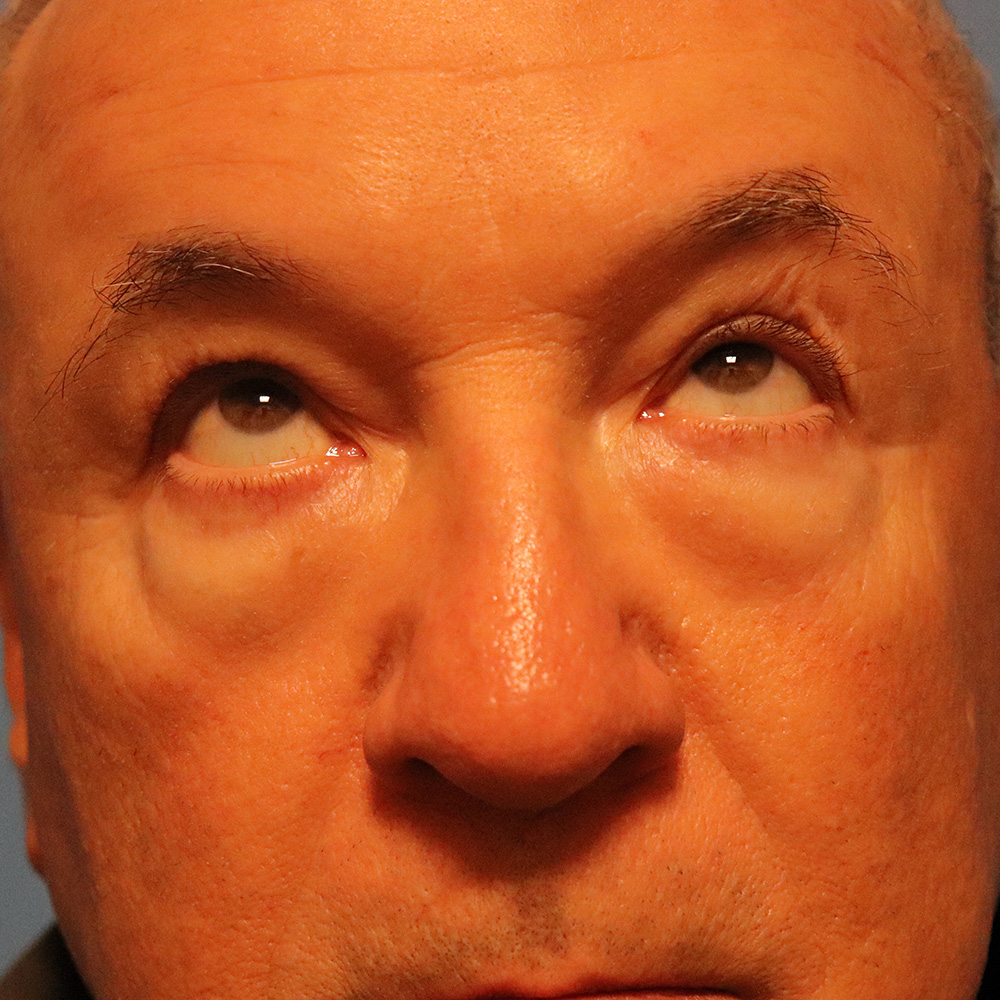 Case--7502 | Before Blepharoplasty 2