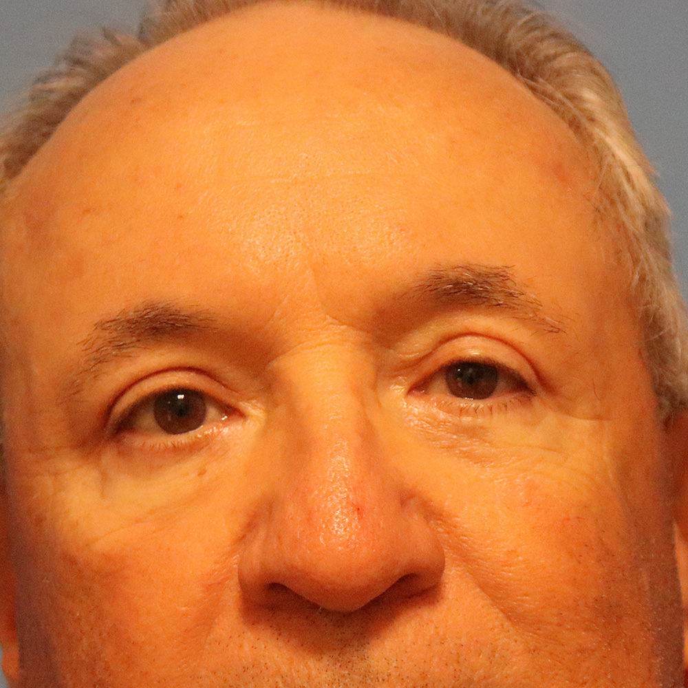 Case--7502 | After Face