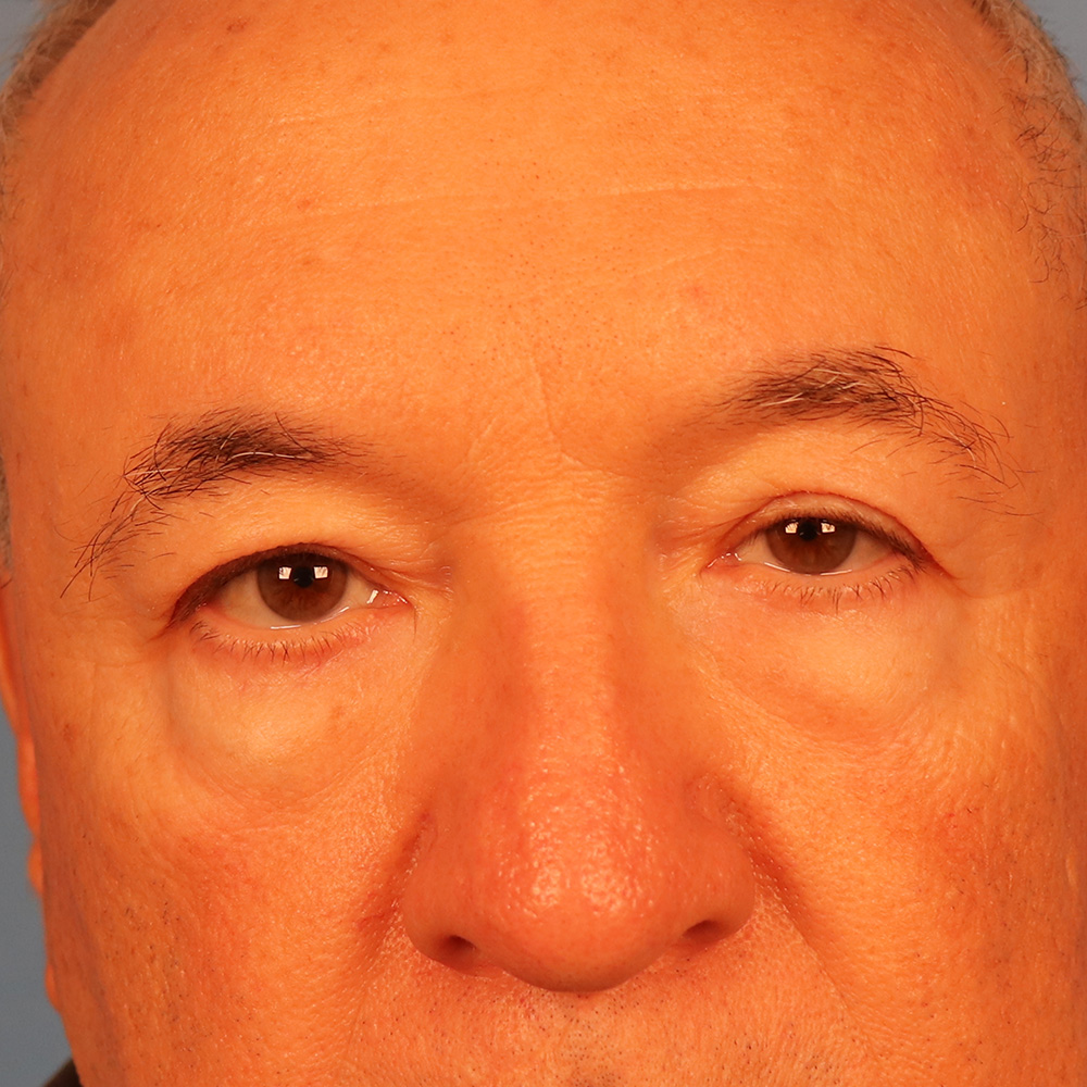 Case--7502 | Before Face