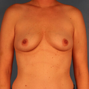 Case--6471 | Before Augmentation Mastopexy 1