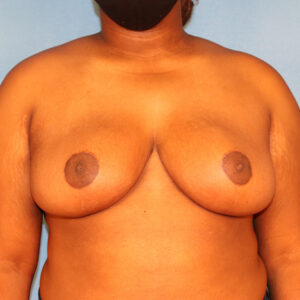 Case--3223 | After Bilateral Reduction Mammaplasty (Breast Reduction) 1