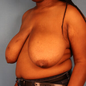 Case--3223 | Before Bilateral Reduction Mammaplasty (Breast Reduction) 2