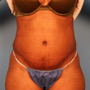 Case--5980 | After Abdominoplasty 1