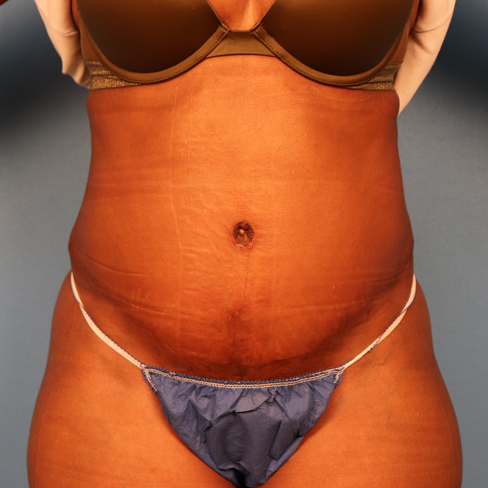 Case--5980 | After Body