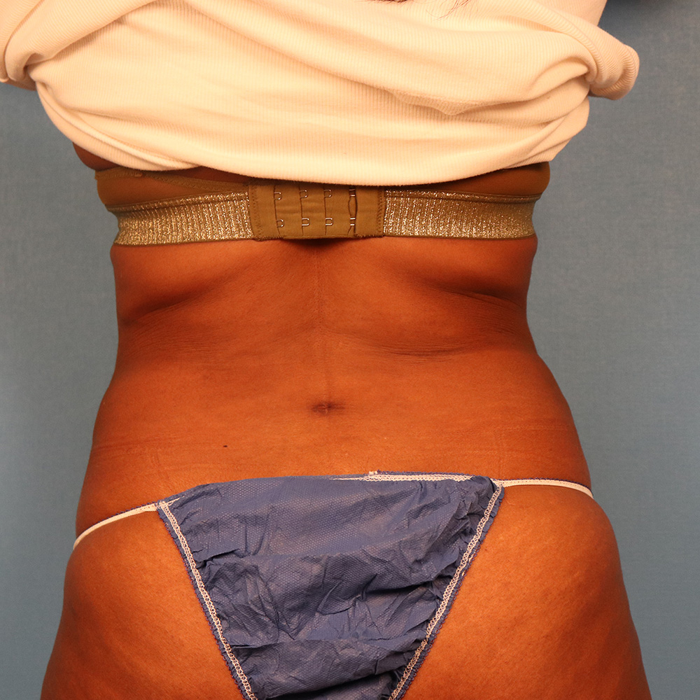 Case--2488 | After Liposuction