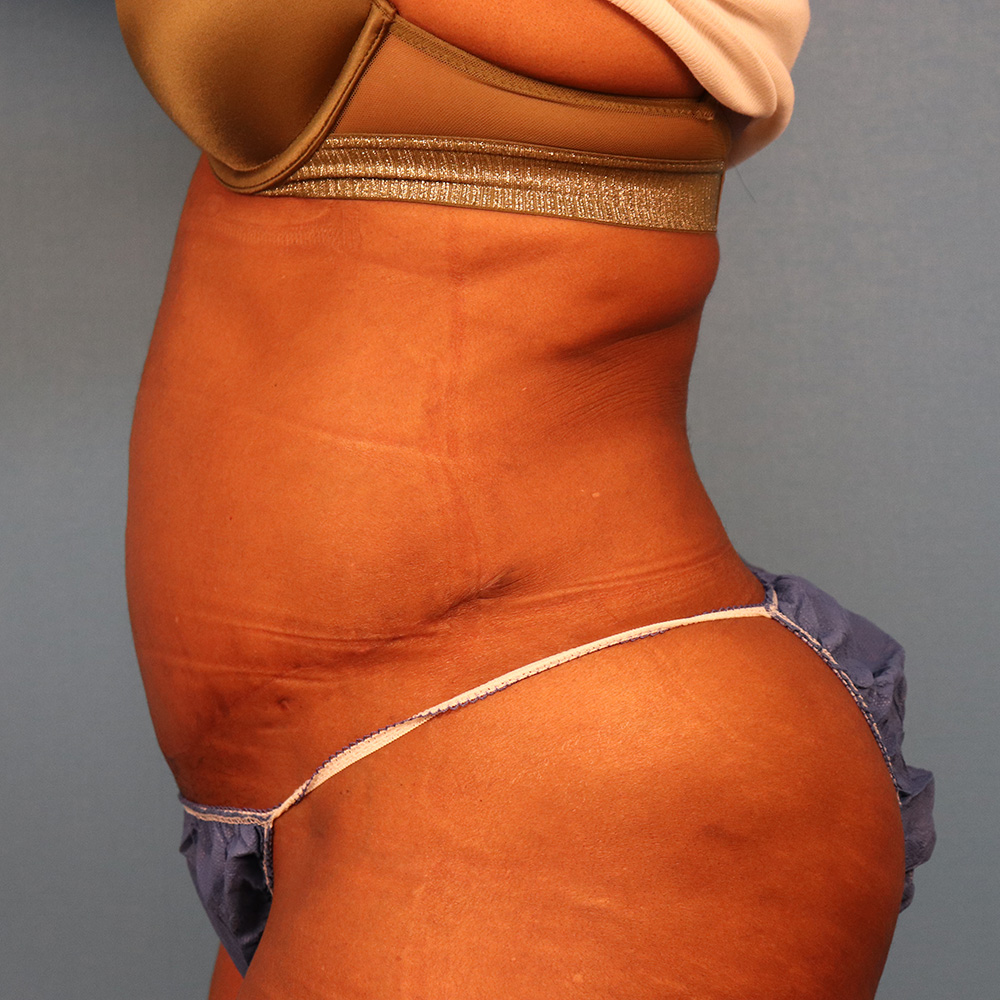 Case--5980 | After Abdominoplasty 2