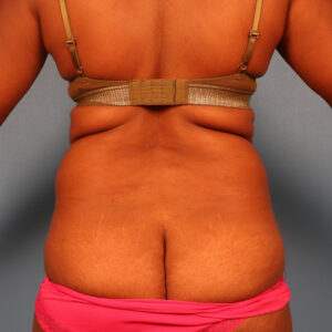 Case--2488 | Before Body 1