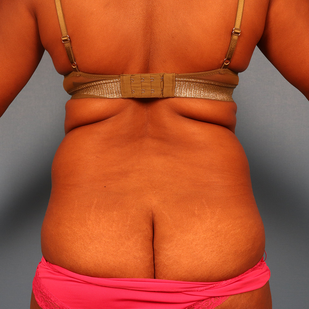 Case--2488 | Before Liposuction