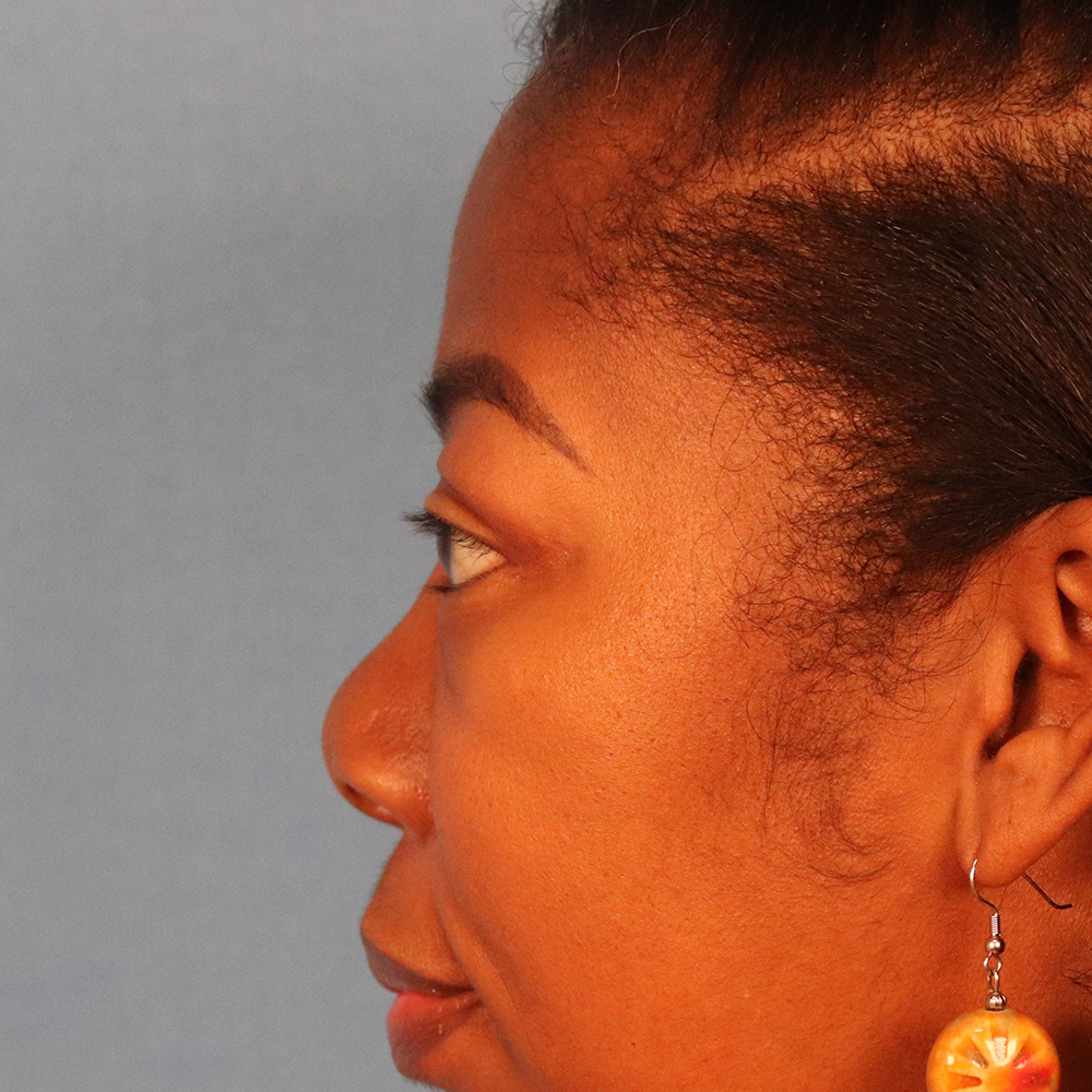 Case--1793 | After Blepharoplasty 2