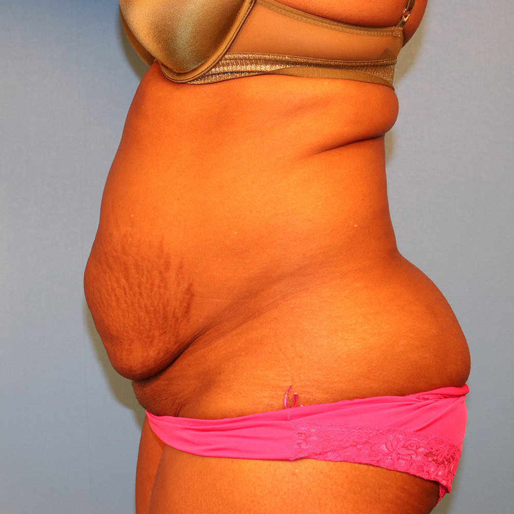 Case--5980 | Before Abdominoplasty 2