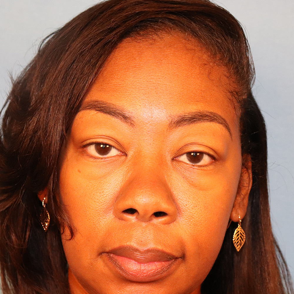 Case--1793 | Before Face