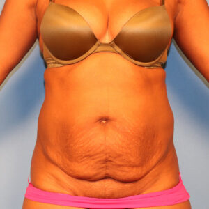 Case--5980 | Before Abdominoplasty 1