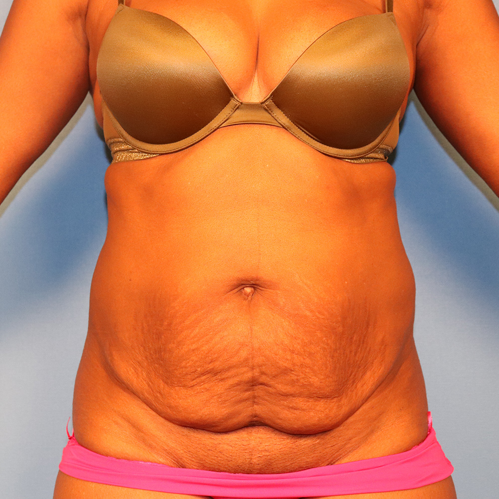 Case--5980 | Before Body