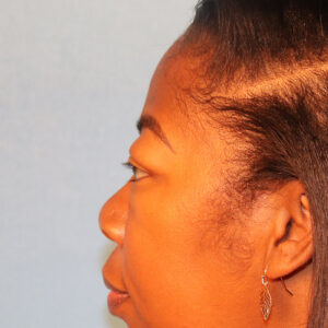 Case--1793 | Before Face 2