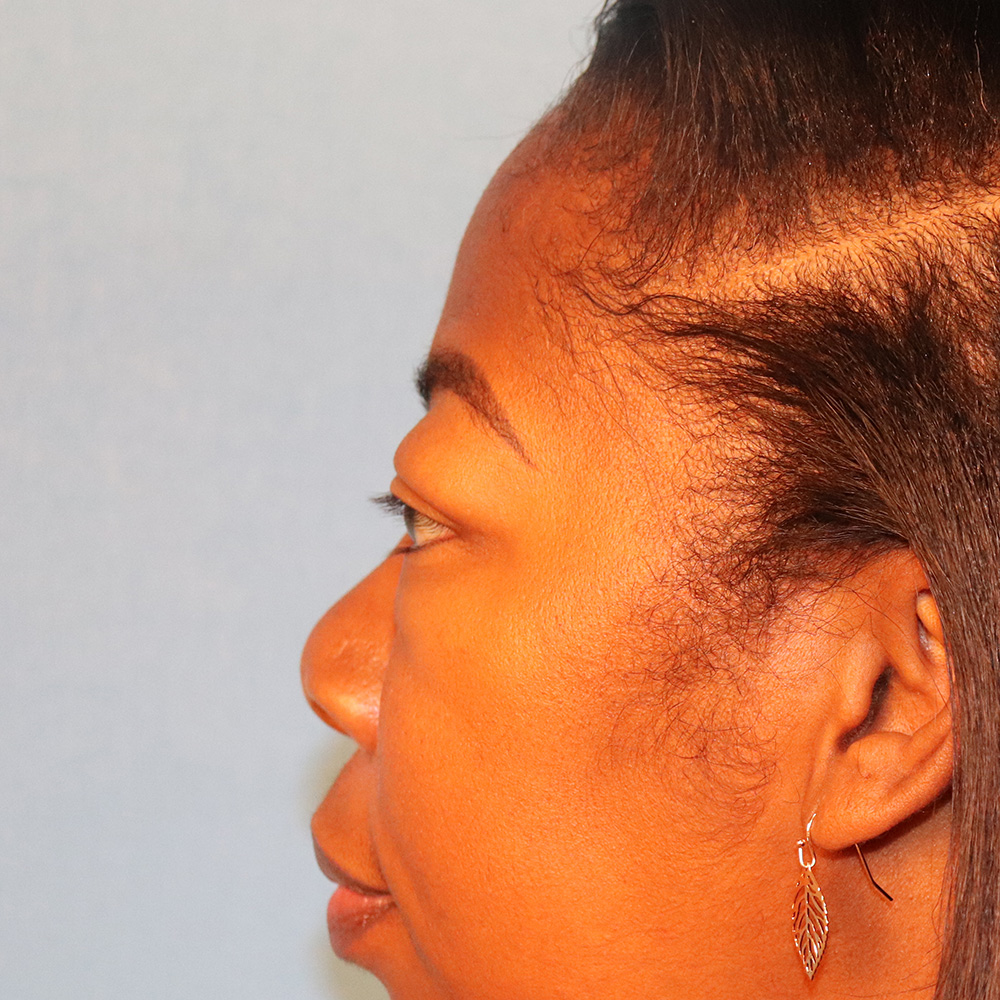 Case--1793 | Before Blepharoplasty 2