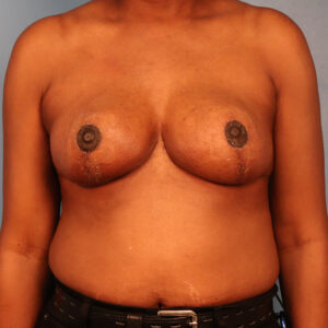 Case--1240 | After Bilateral Reduction Mammaplasty (Breast Reduction) 1
