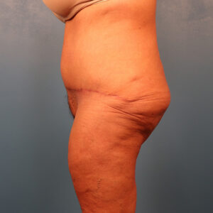 Case--58971 | After Tummy Tuck (Abdominoplasty) 2