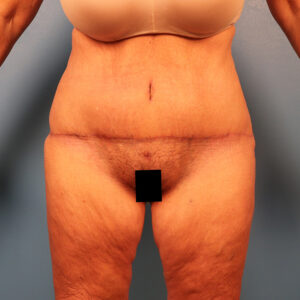 Case--58971 | After Tummy Tuck (Abdominoplasty) 1