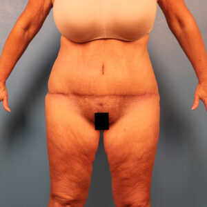 Case--1930 | After Abdominoplasty 1