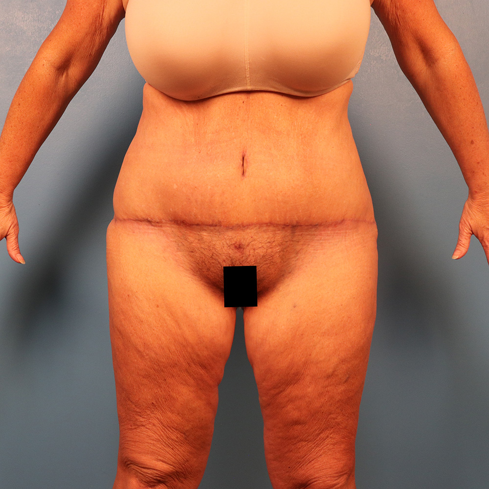 Case--1930 | After Abdominoplasty