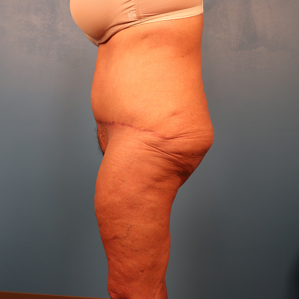 Case--1930 | After Abdominoplasty 2