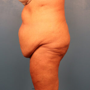 Case--58971 | Before Tummy Tuck (Abdominoplasty) 2