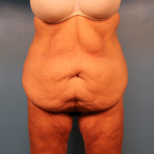 Case--58971 | Before Tummy Tuck (Abdominoplasty) 1