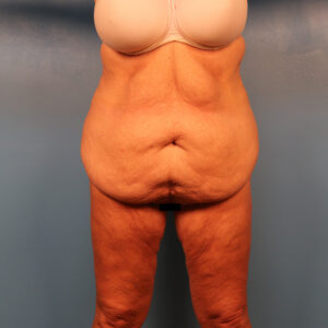 Case--1930 | Before Abdominoplasty 1
