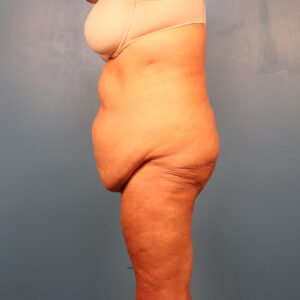 Case--1930 | Before Abdominoplasty 2
