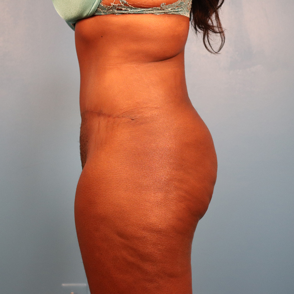 Case--6395 | After Abdominoplasty 2