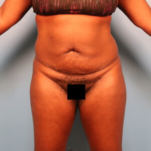 Case--6395 | Before Abdominoplasty 1