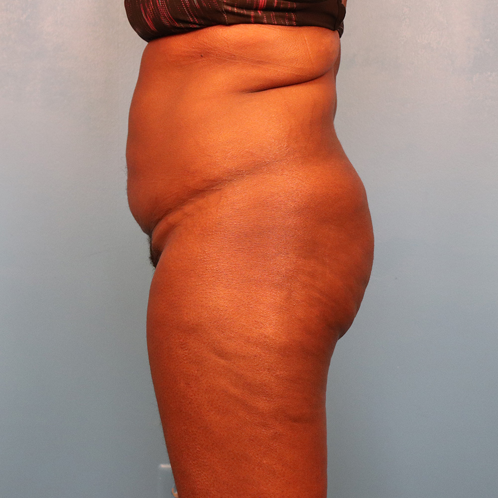 Case--6395 | Before Abdominoplasty 2