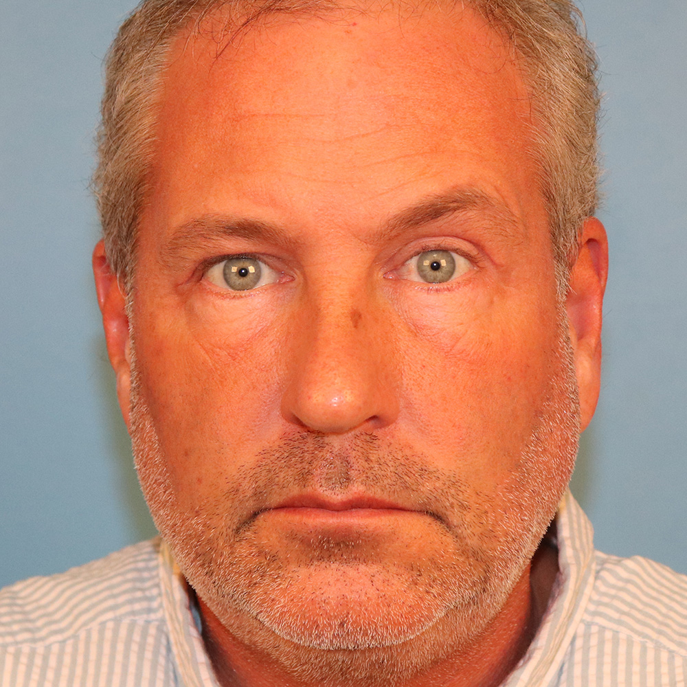 Case--5033 | After Blepharoplasty