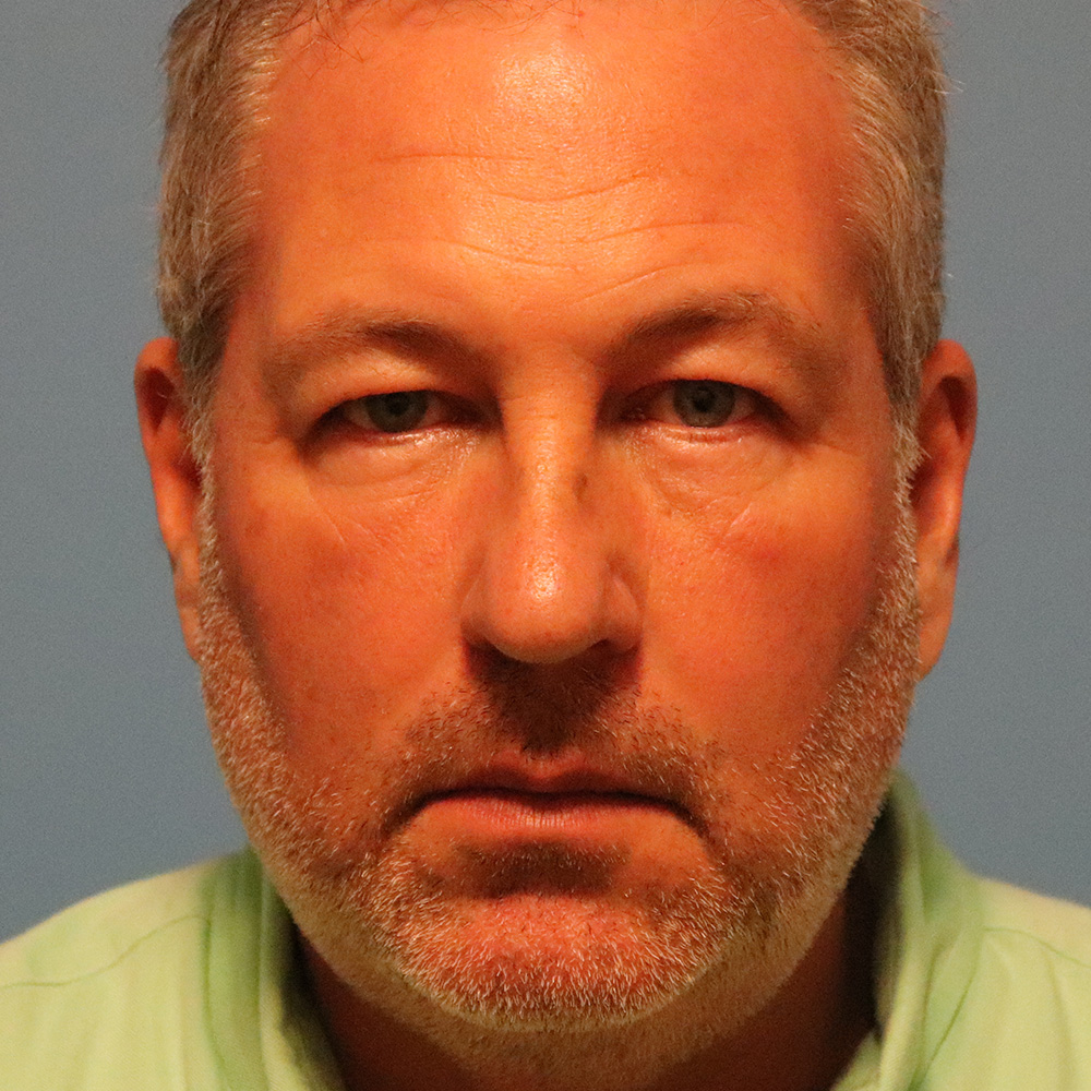 Case--5033 | Before Blepharoplasty