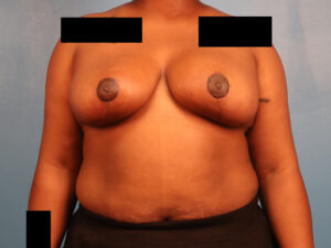 Case--60591 | After Breast 1
