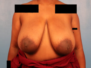 Case--60591 | Before Breast 1