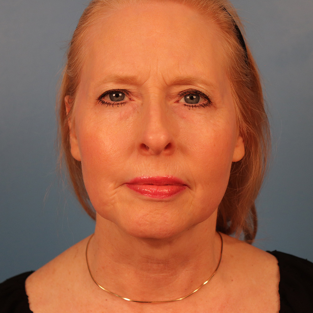 Case--4970 | After Sciton Laser