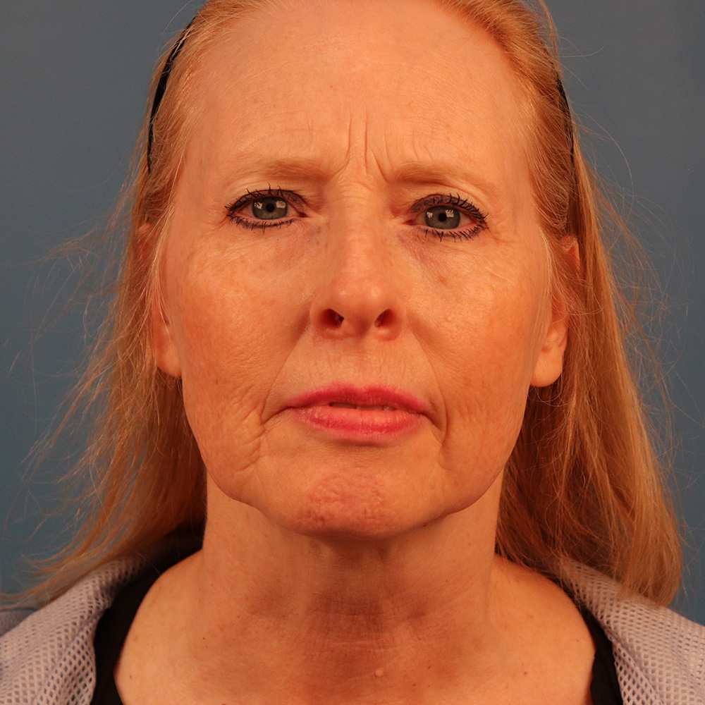 Case--4970 | Before Sciton Laser