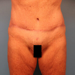 Case--60743 | After Tummy Tuck (Abdominoplasty) 1