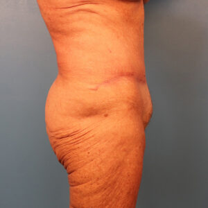 Case--60743 | After Tummy Tuck (Abdominoplasty) 2