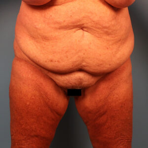 Case--60743 | Before Tummy Tuck (Abdominoplasty) 1