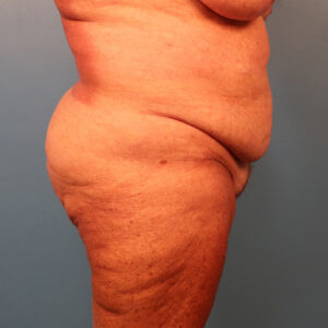 Case--60743 | Before Tummy Tuck (Abdominoplasty) 2