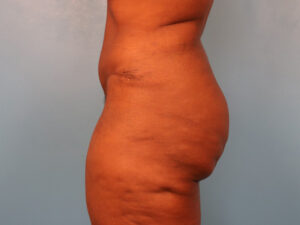 Case--60849 | After Tummy Tuck (Abdominoplasty) 2