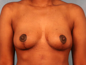 Case--60849 | After Breast 1