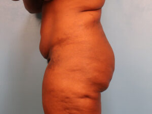 Case--60849 | Before Tummy Tuck (Abdominoplasty) 2